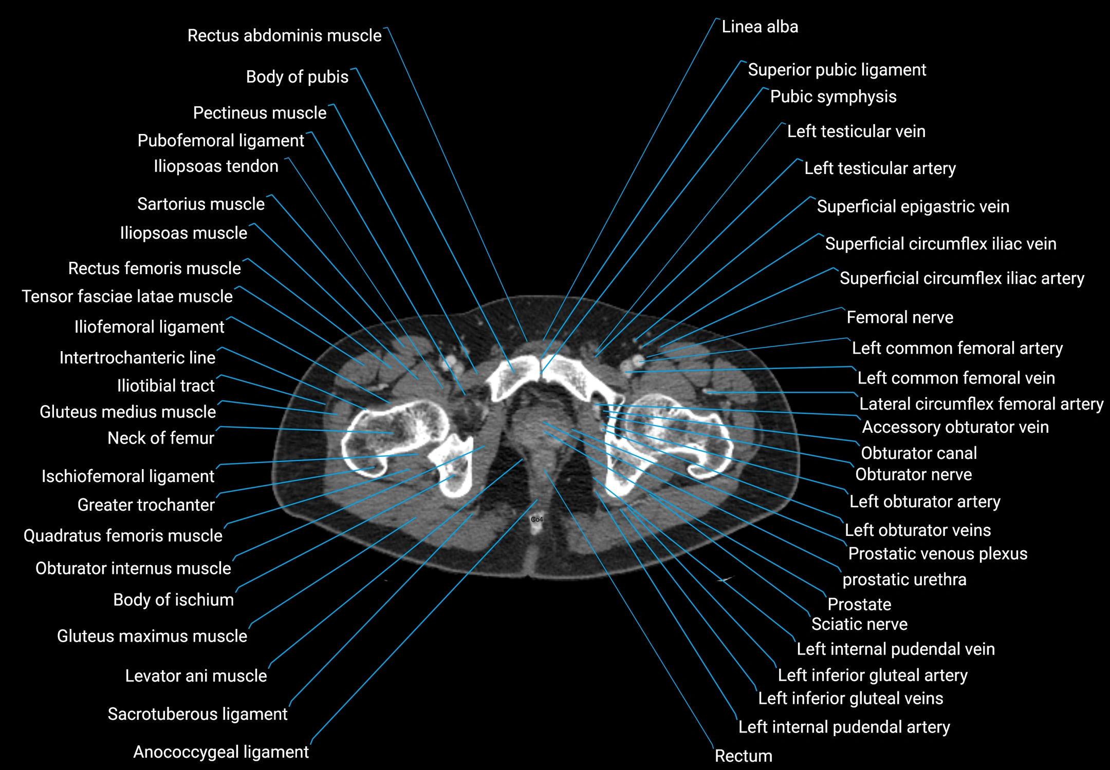 CT male pelvis axial cross sectional anatomy labelled radiology image -00196.webp